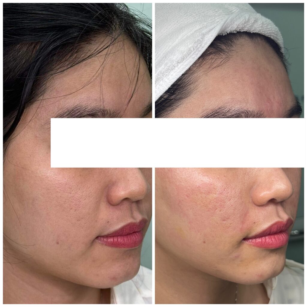 Hình ảnh trước và sau điều trị liệu pháp điều trị sẹo rỗ, sẹo lồi và sẹo hỗn hợp – Từ khóa gốc: before_after, before_after_seo_13.jpg, seo.