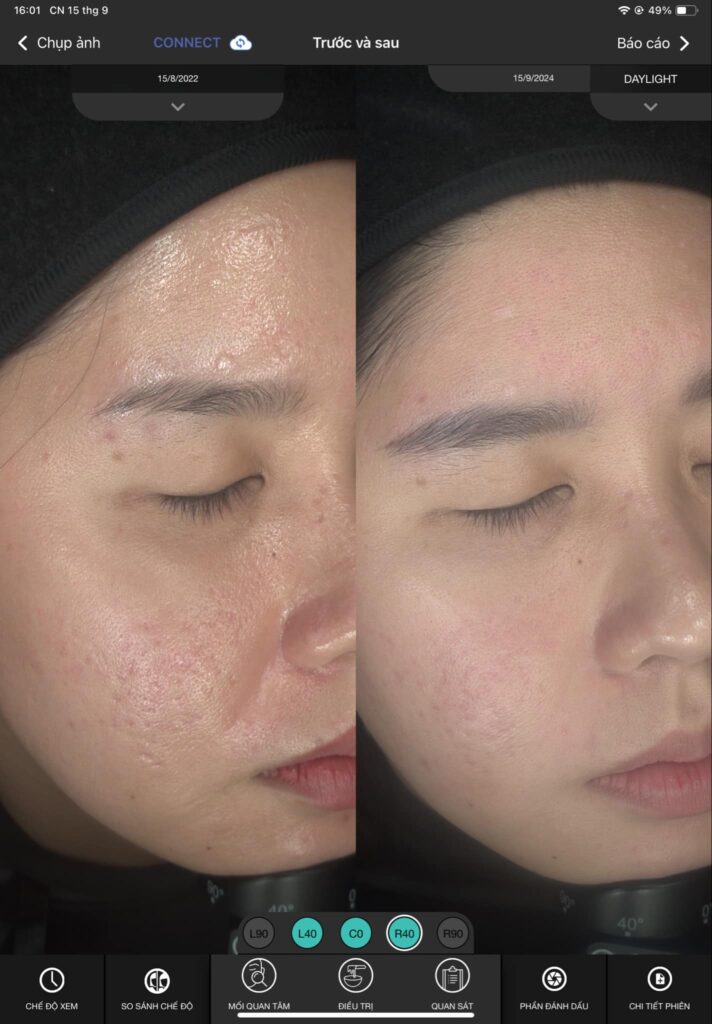 sẹo mụn phòng dễ hơn trị, sẹo mụn, phòng sẹo mụn, ngăn ngừa sẹo mụn, mụn viêm, trị sẹo mụn