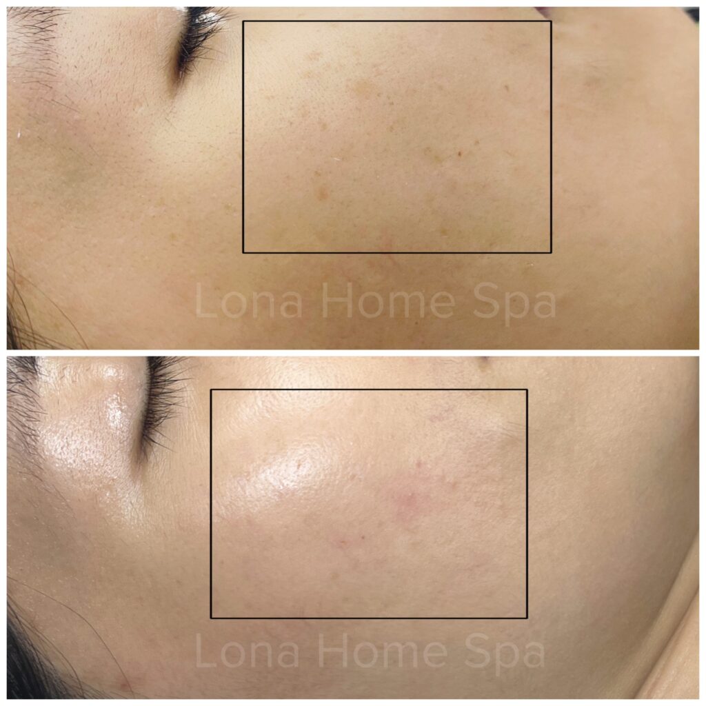 Vitamin C Juliette Armand, Tranexamic Acid, tàn nhang, trị tàn nhang, làm sáng da