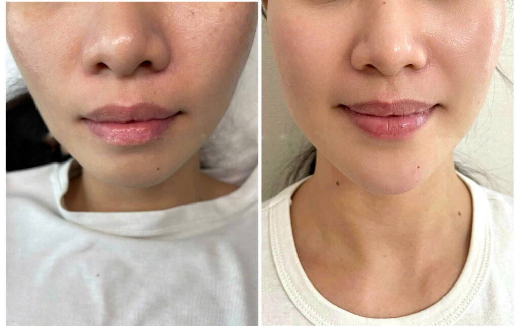 công nghệ xóa nhăn, công nghệ xóa nhăn, thẩm mỹ 2025, Ultherapy Maxpro 2025, HIFU, Thermage FLX