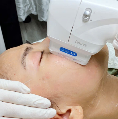 HIFU, HIFU, thời gian điều trị HIFU, tư vấn HIFU, công nghệ HIFU,