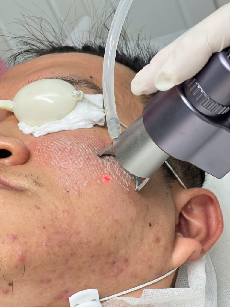 Hình ảnh thể hiện quy trình Laser CO2 Fractional, góp phần điều trị sẹo bằng laser CO2 và tái tạo da trong liệu pháp trẻ hóa da bằng laser CO2, 