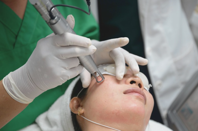 Trị mất sắc tố da, Rạn da trắng: Bắn laser theo liều phù hợp