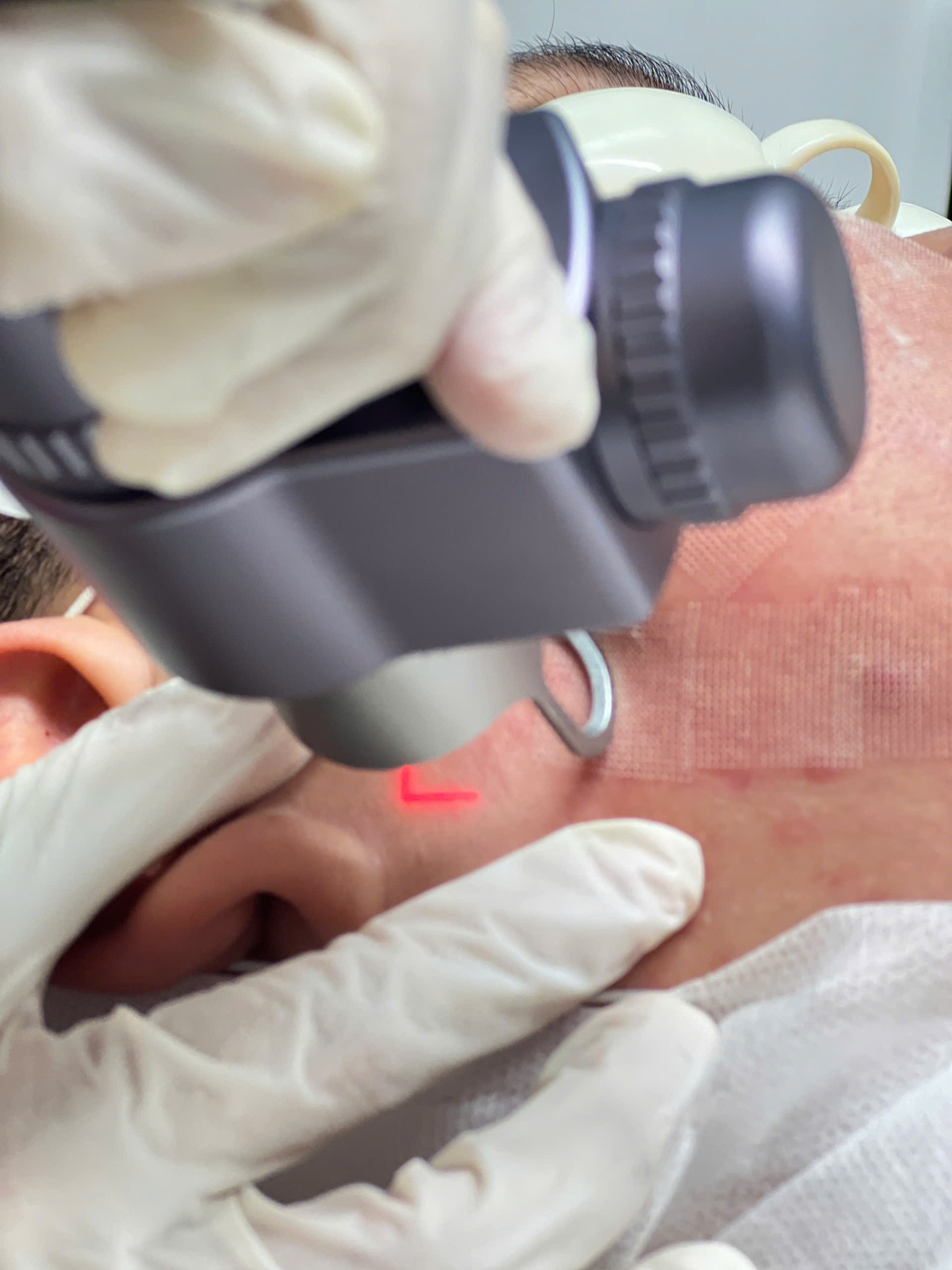 Quy trình phục hồi và Rạn da trắng: Chăm sóc da hiệu quả sau laser