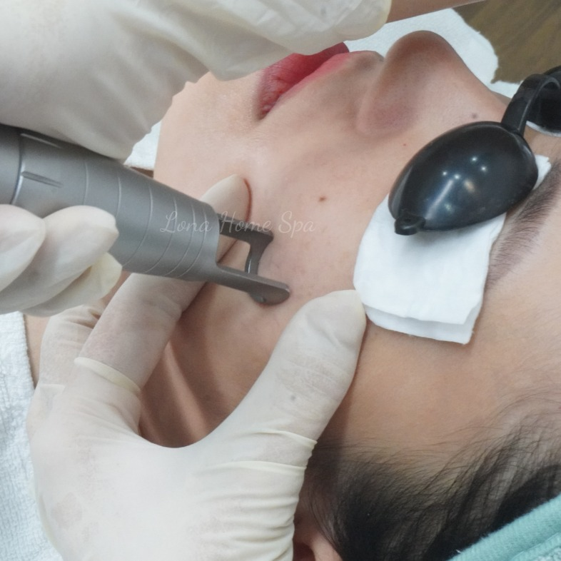 Năng lượng laser & Rạn da trắng: Điều chỉnh liều phù hợp cho da