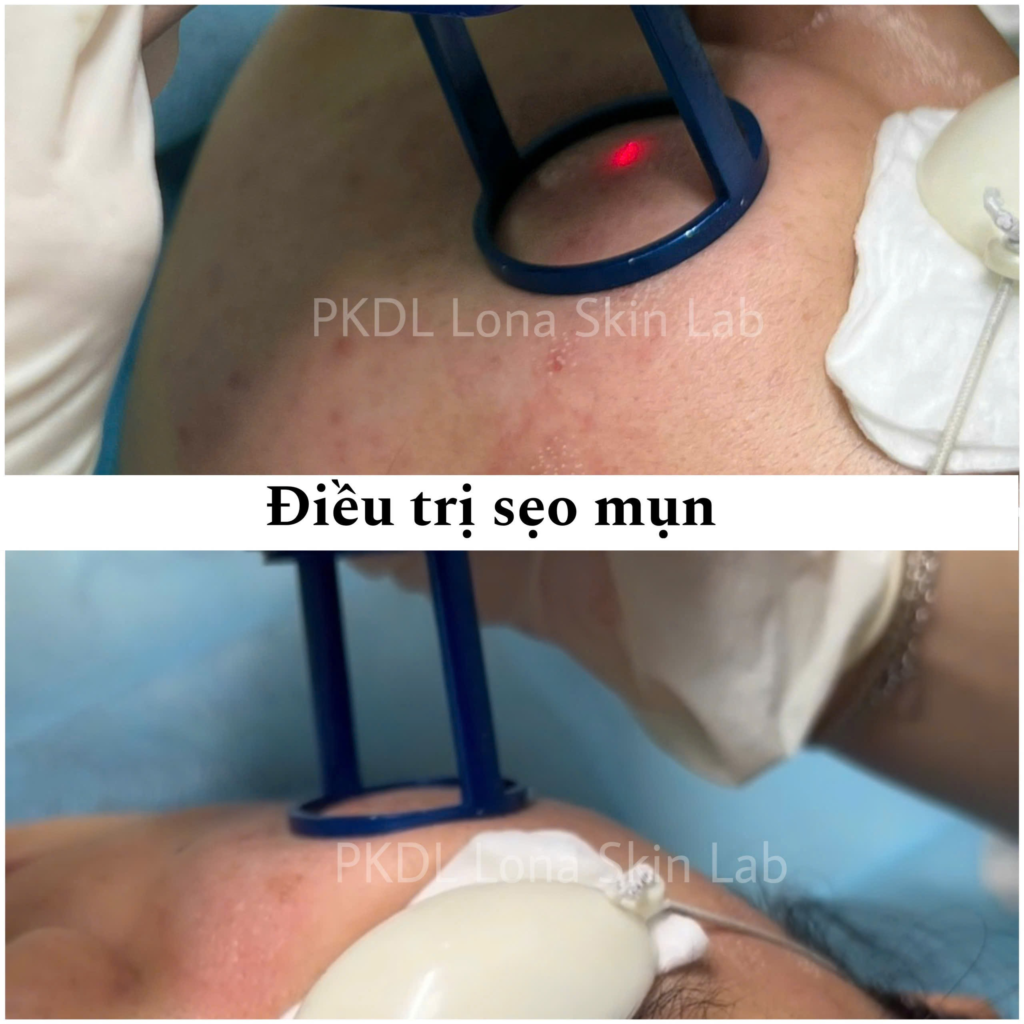 Hình ảnh thực hiện liệu pháp laser Fractional/CO2 điều trị chuyên sâu – Từ khóa gốc: laser, laser_seo_mun_1.png.
