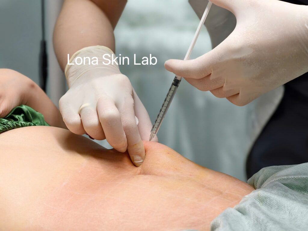 Hình ảnh thực hiện liệu pháp tiêm mesotherapy nuôi dưỡng và phục hồi da – Từ khóa gốc: meso, meso_bung_3.jpg.