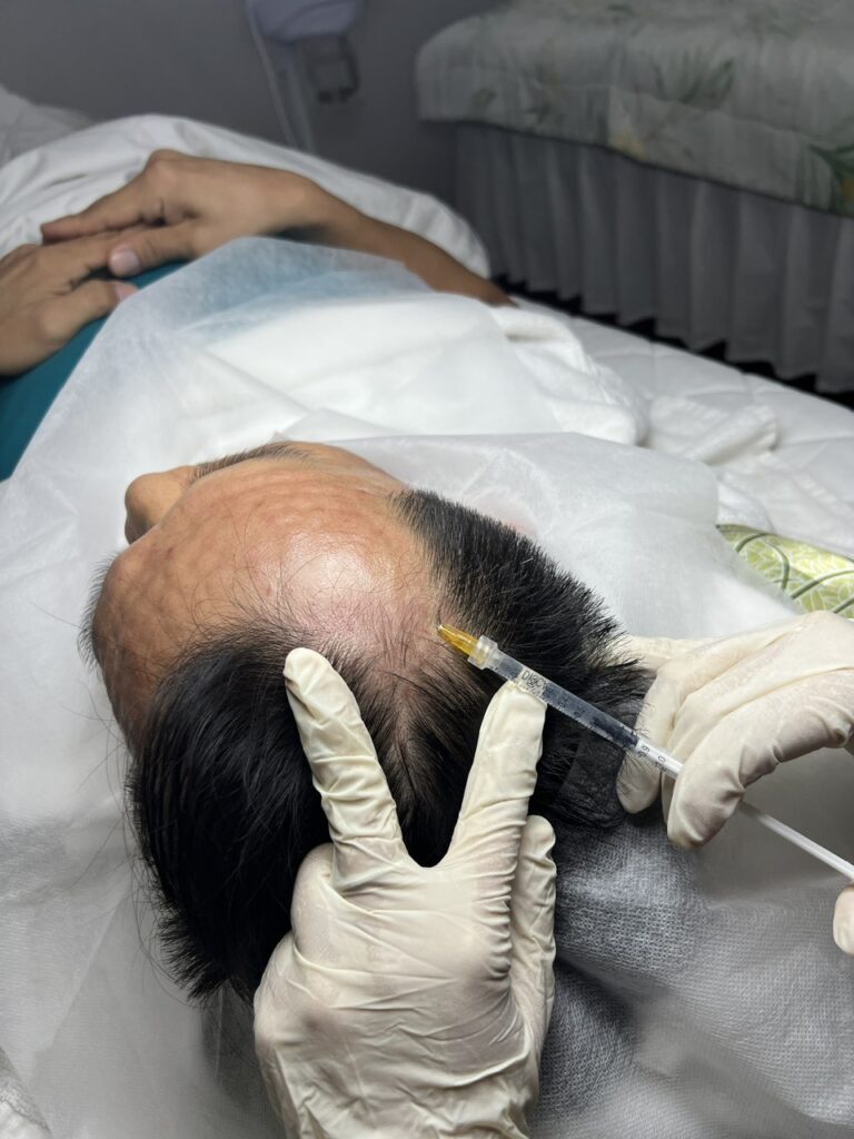 mesotherapy không hiệu quả, mesotherapy, tiêm meso, làm đẹp, tái tạo da, Lona Skin Lab