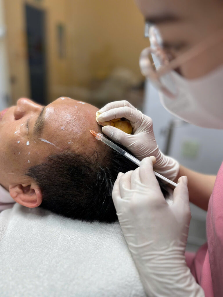 Phương pháp tiêm meso được áp dụng cùng mesotherapy trong quá trình trẻ hóa da, góp phần điều trị nám và điều trị mụn, phản ánh nguyên tắc 'tiêm meso là gì' qua từng mũi tiêm chính xác.
