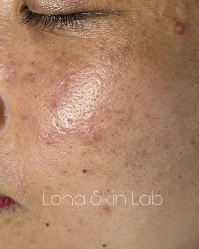 Không gian trị liệu hiện đại tại PKDL LONA SKIN LAB được trang bị thiết bị kỹ thuật cao, đảm bảo rằng PKDL LONA SKIN LAB luôn tiên phong trong ứng dụng công nghệ làm đẹp.