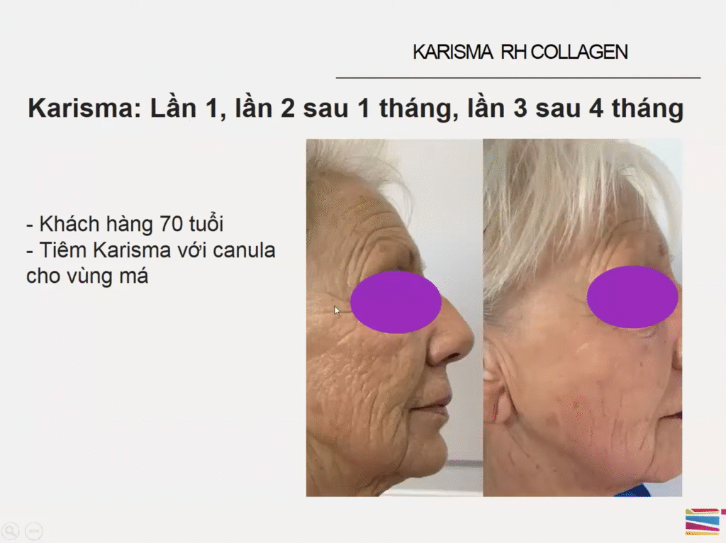 Ảnh minh họa về phục hồi nền da mỏng ở độ tuổi trung niên này giúp làm rõ Karisma là gì trong bối cảnh điều trị tái tạo da.