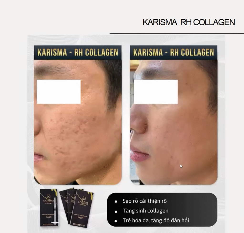 Trường hợp điều trị cho bệnh nhân chứng minh hồi phục Karisma vượt trội, qua đó khẳng định vai trò của hồi phục Karisma trong phục hồi da chuyên sâu.