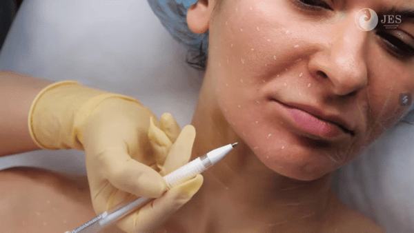 Những sai lầm cần tránh khi tiêm Karisma