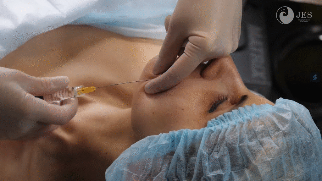 Lợi ích của Công dụng của tiêm Karisma được minh chứng qua việc sử dụng kỹ thuật canula, giúp cải thiện Karisma sau laser bằng việc kích thích tăng sinh collagen và ổn định ECM.