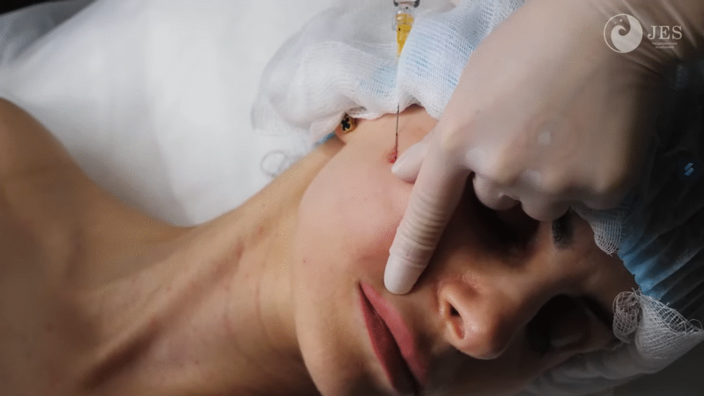 Sơ đồ tiêm Karisma minh họa cách xác định điểm tiêm Karisma và phân bố các điểm tiêm Karisma chuẩn xác; kỹ thuật tiêm Karisma với 15 điểm tiêm Karisma đảm bảo hiệu quả điều trị.