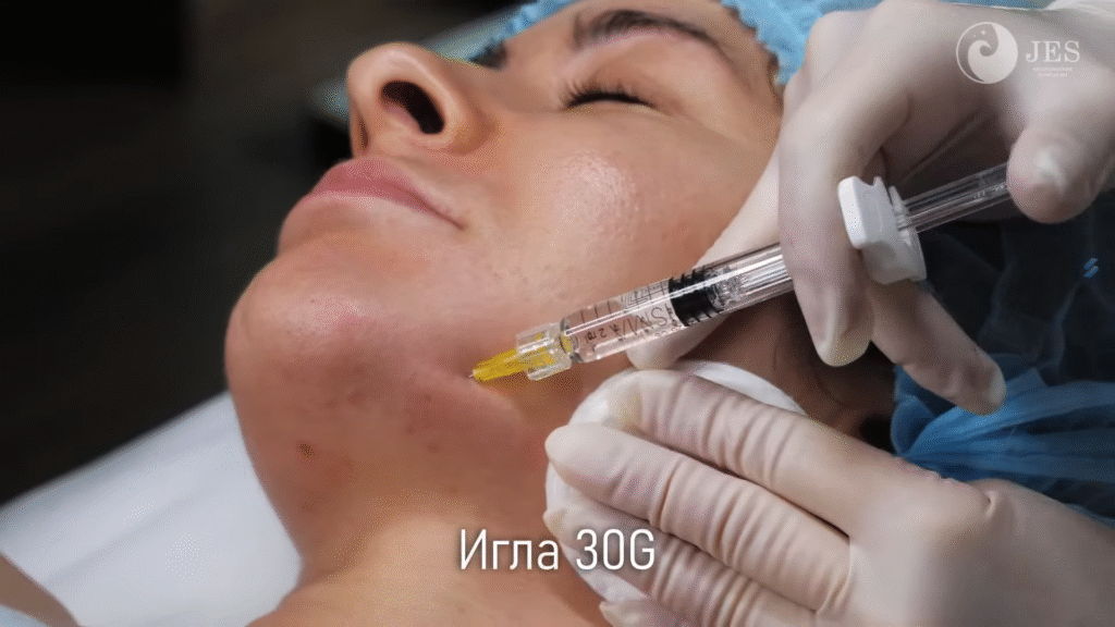 Liệu trình tiêm Karisma được thực hiện theo chuẩn khoa học; liệu trình tiêm Karisma mang lại hiệu quả điều trị vượt trội trong việc kích thích collagen type I nội sinh và tái tạo ECM.