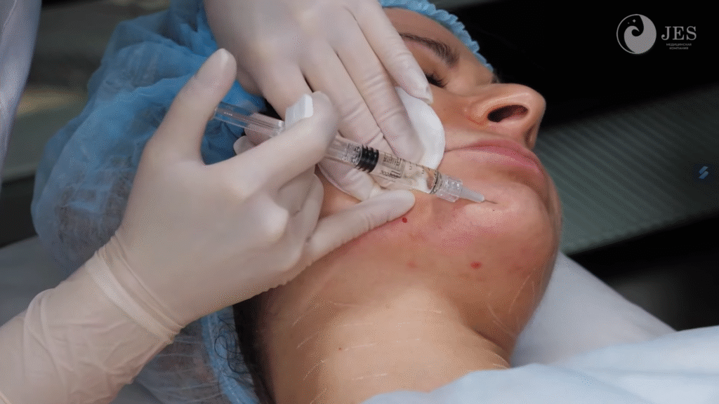 So sánh với filler thông thường: Khác với các phương pháp filler truyền thống, công dụng Karisma được đánh giá dựa trên cơ chế kích thích tăng sinh tự nhiên, mang lại hiệu quả trẻ hóa da ổn định theo da liễu chuyên sâu.