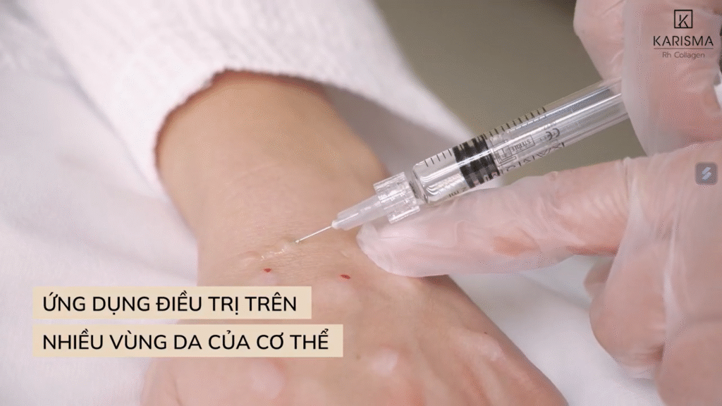 Trẻ hóa mu bàn tay với Karisma: Áp dụng công dụng Karisma trong khu vực da mỏng như bàn tay cho thấy tính hiệu quả cao nhờ khả năng tăng sinh collagen, giúp tái tạo và trẻ hóa làn da một cách tự nhiên.